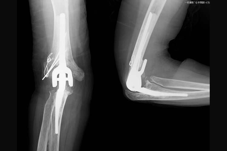 半拘束型人工肘関節写真
