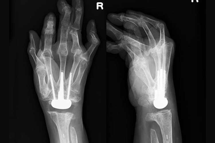 人工手関節写真