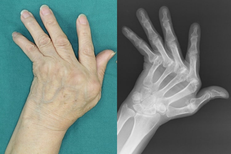 リウマチ術前写真