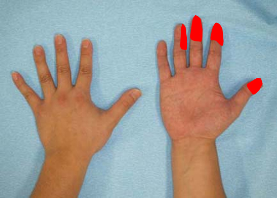 手根管症候群で痺れる領域 (赤)