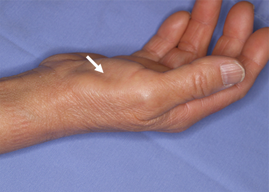 進行すると親指の付け根の筋肉 (母指球筋) が痩せてきます