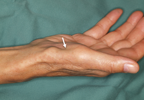 手根管開放術と母指対立再建術