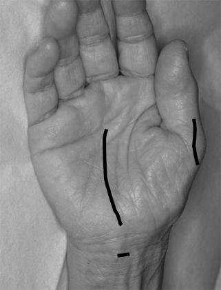 母指対立再建術