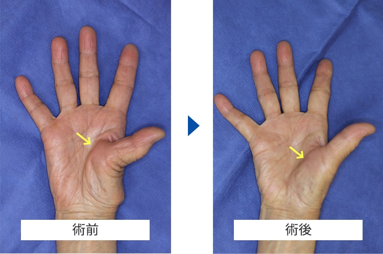 母指CM関節症 術前・術後