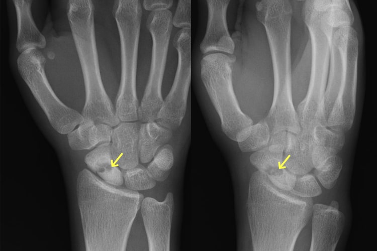 舟状骨骨折写真