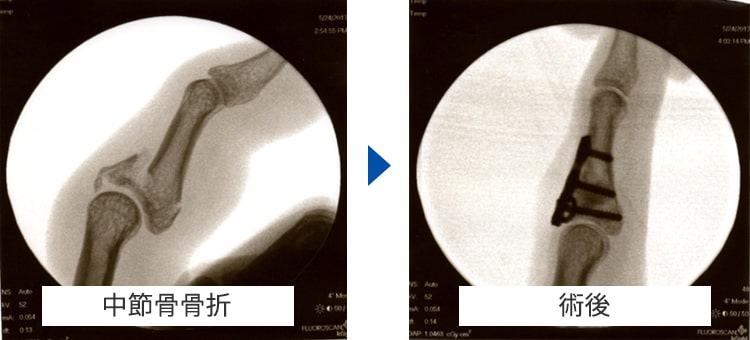 中手骨骨折 術前・術後写真