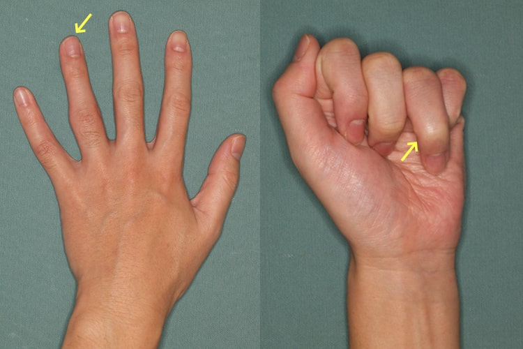 指骨・中手骨骨折写真