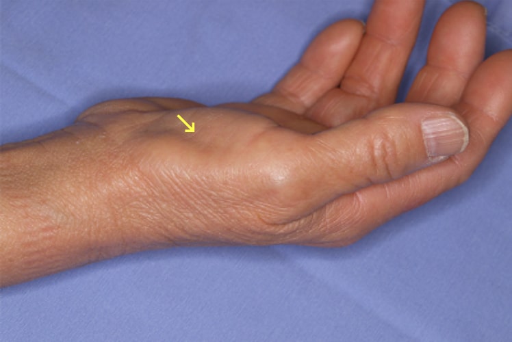 手根管症候群写真2