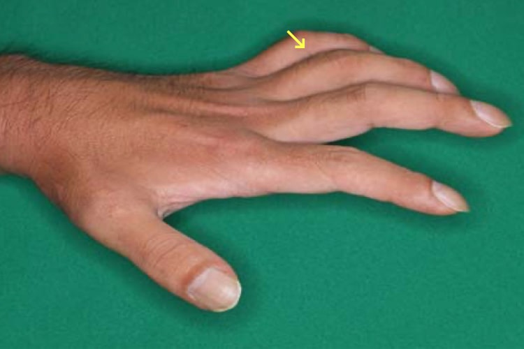 肘部管症候写真2