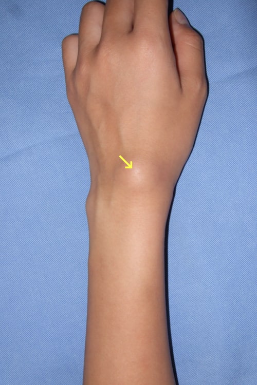 ガングリオン写真