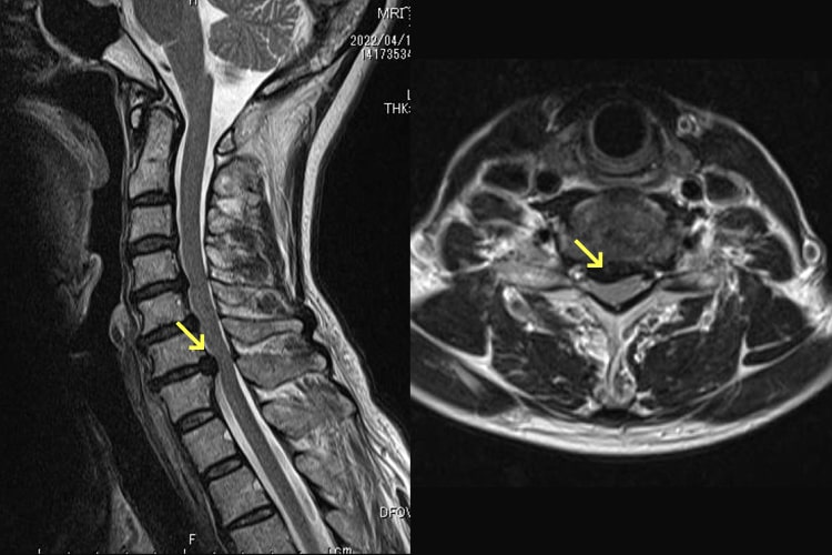 頚椎椎間板ヘルニア写真