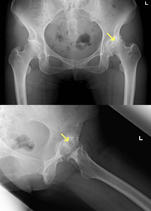 変形性股関節症写真
