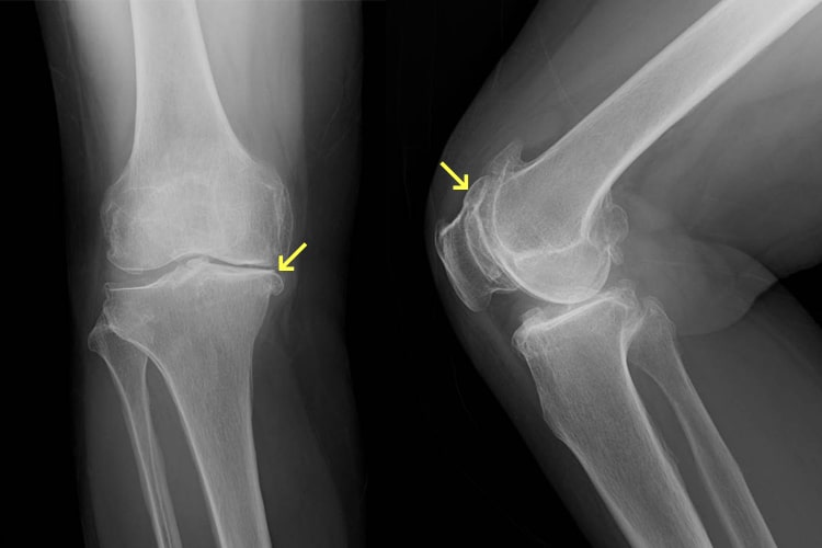 変形性膝関節症写真