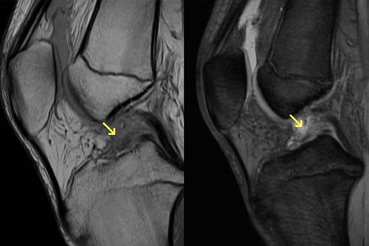 前十字靭帯損傷写真