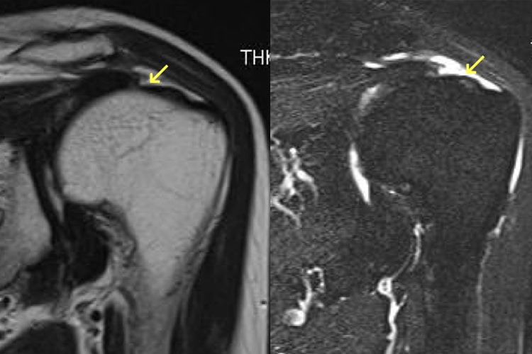 肩腱板断裂写真