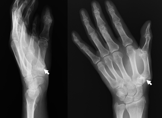 母指CM関節症とは