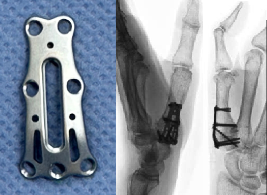 母指CM関節症の手術について