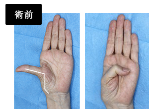 母指CM関節固定術