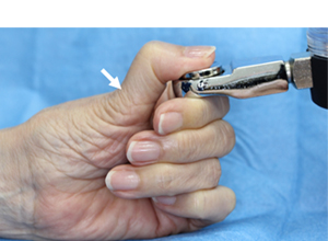 母指CM関節固定術