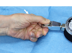 母指CM関節形成術