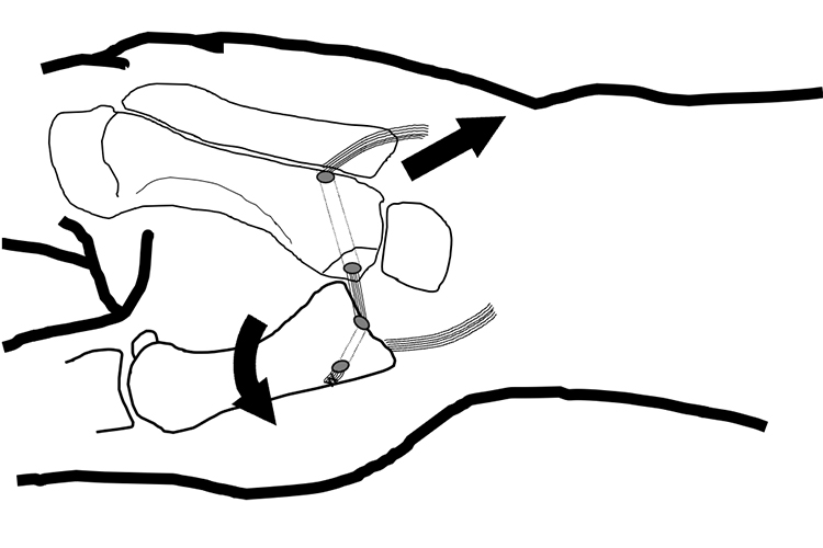 長掌筋腱を用いたThompson変法
