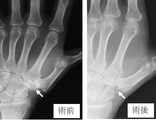 長掌筋腱を用いたThompson変法